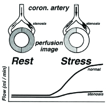 myocardial perfusion scan